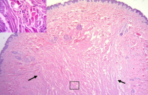 Bordetelosis